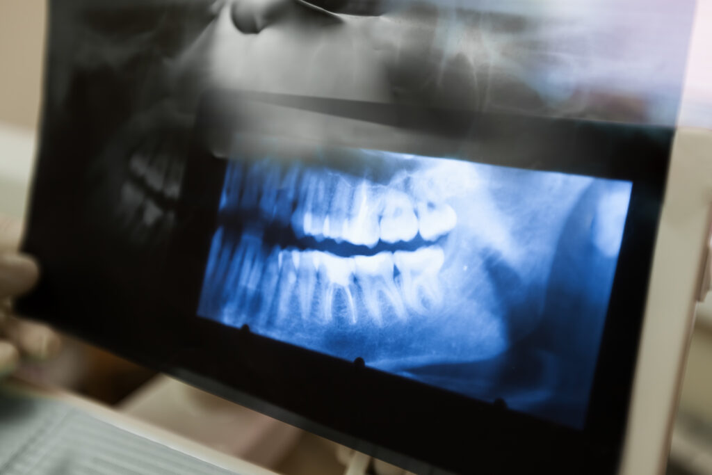 Dental crowns in southern utah