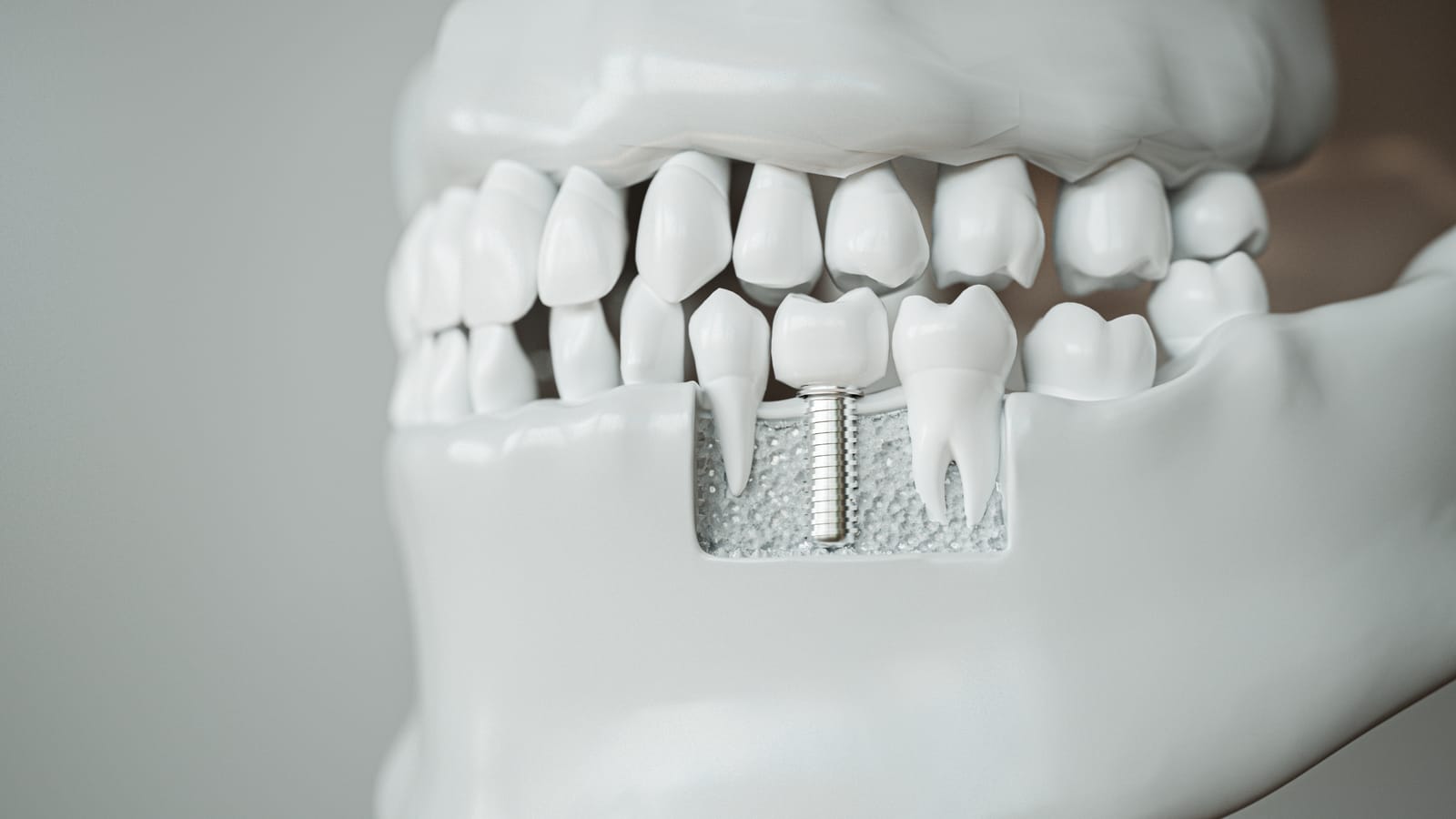 Dental Implants at Save Dental in St. George, Utah